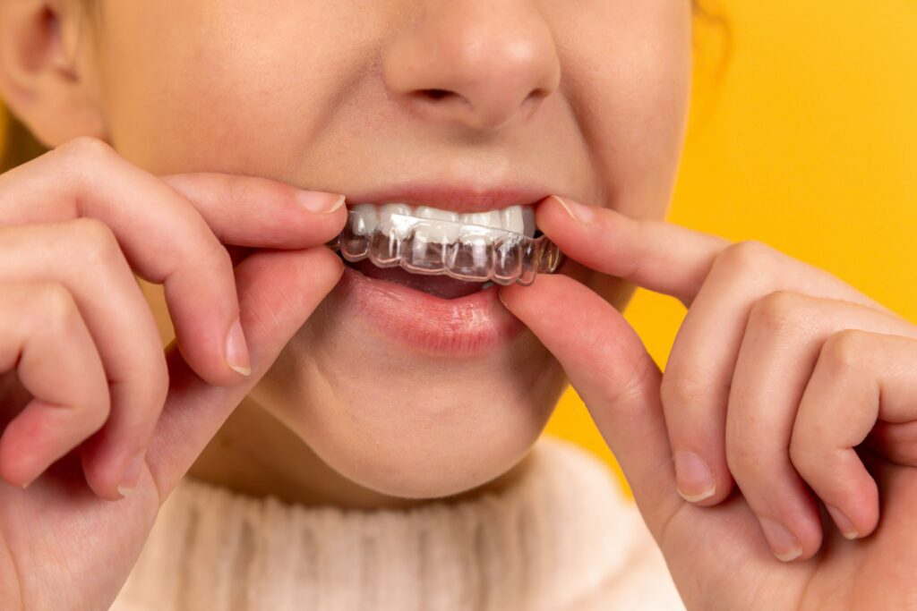 A close-up on a child placing Invisalign-style braces onto their top teeth. 
