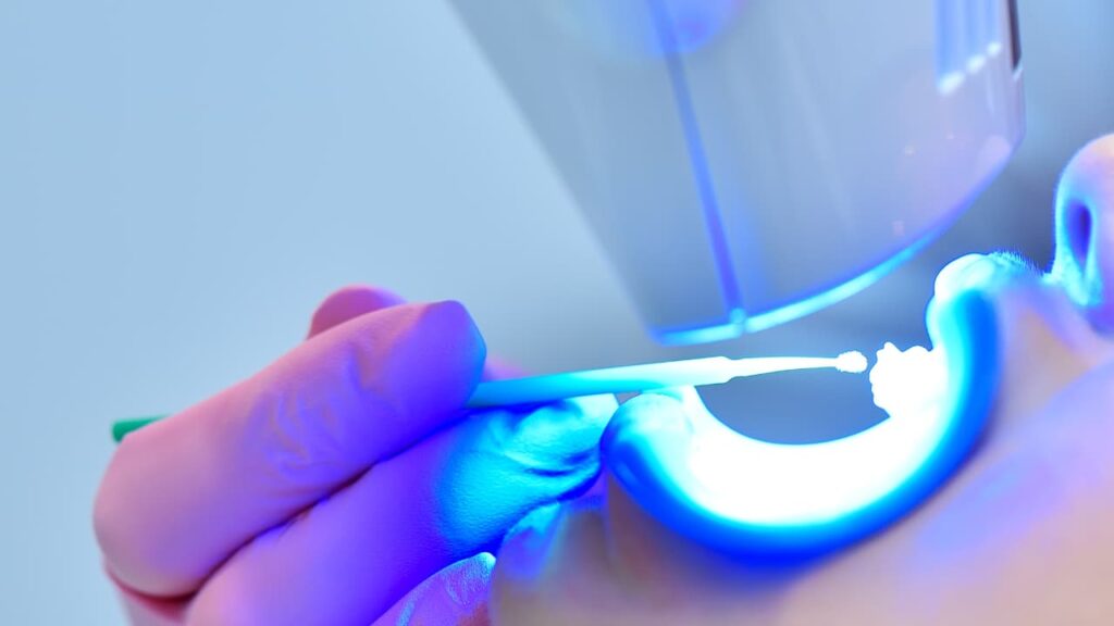 A child wears a retractor for a teeth whitening procedure