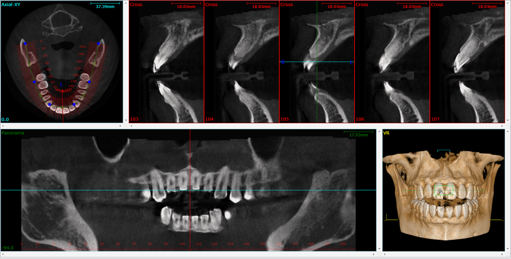 A comparison of conventional X-rays with a 3D CBCT reconstruction